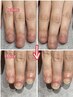 【男性】深爪矯正長さだし　自爪そっくり