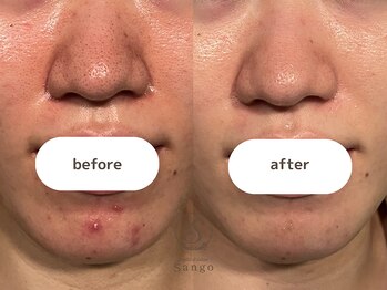 サンゴ(Sango)/ニキビ/毛穴黒ずみ改善