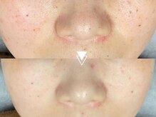 韓国肌管理◎冬の肌乾燥が気になる方！【毛穴洗浄/ハリツヤ】ハイドラ＋水玉グロウリフト(LDM)11000円