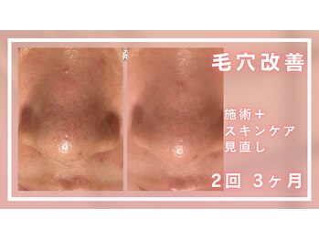 シャルナ(charna)/毛穴改善