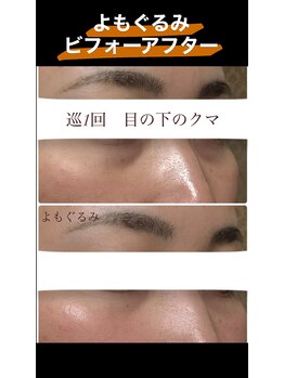 よもぐるみ 桃山台店/ビフォーアフター[よもぎ蒸し]