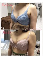 マイントゥー(mine too)/バストアップ症例