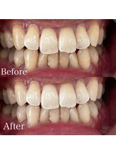 ホワイトニングカフェ 吉祥寺店(WhiteningCafe)/8回コース / ビフォーアフター
