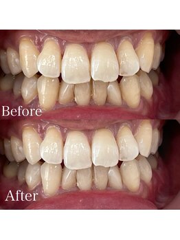 ホワイトニングカフェ 吉祥寺店(WhiteningCafe)/8回コース / ビフォーアフター