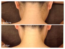 ミースプラス(me,as+)/毛穴縮小脱毛 / うなじ 11回