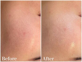 サロンドフェイス(Salon de Faith)/【ハーブピーリング】1回施術♪