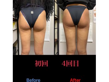 美尻研究所 福岡大名店/横の凹み、左右差改善