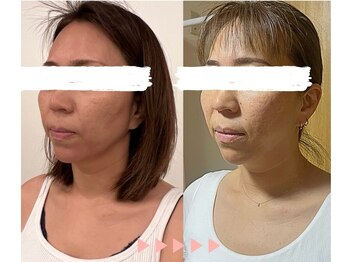 サリー(Sally)/小顔　Bfore After