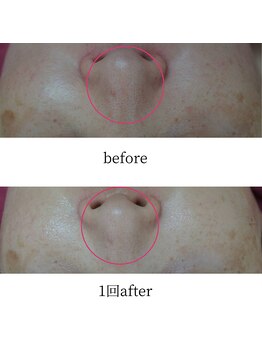 アップルミント/＜フェイシャル＞before・after