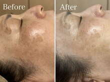 【ガリレオピーリング】肌質改善/シミ/毛穴/シワ/ニキビのケア