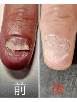 巻き爪補正店 松本店/初回の施術