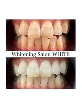 ホワイトニングサロン ホワイト 前橋店(WHITE)/一度お試しください