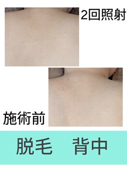 エミナル(EMINAL)/背中脱毛の効果!脱毛/毛穴/