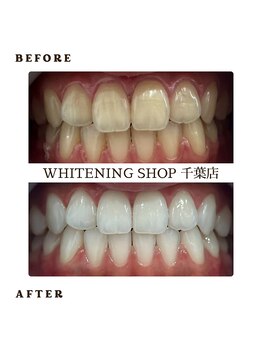 ホワイトニングショップ 千葉店/歯科提携 ホワイトニング専門店