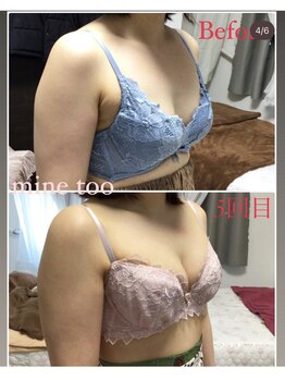 マイントゥー(mine too)/バストアップ症例