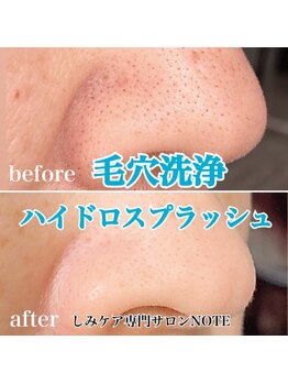 ノート(NOTE)/ハイドロスプラッシュ毛穴洗浄