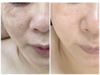 ビスキン(BeSkin)/たるみ|くすみ