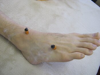 群馬藤岡はりきゅう整体院/お灸