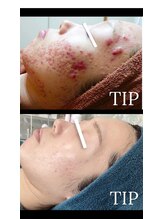 ノヴェイル(NoVeil)/Before/After