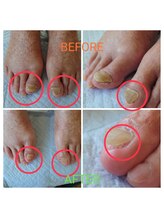 アンティ(Aunty)/爪の変形、肥厚爪