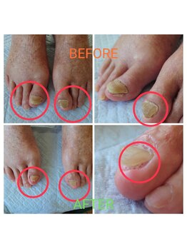 アンティ(Aunty)/爪の変形、肥厚爪