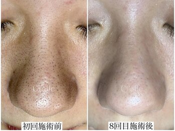 シエール 調布(Ci'aile)/毛穴集中ケア