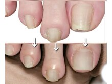 エーケーネイル(AKnail)/巻き爪/肥厚爪