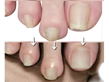 エーケーネイル(AKnail)/巻き爪/肥厚爪