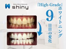 ホワイトニングサロン シャイニー 浜松細島店(shiny)/【超絶・美・白】ホワイトニング