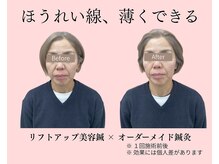 望鍼灸院/美容鍼の施術前後　２