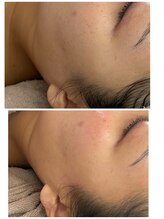 リノ(Lino)/マツヤニ＆世界一の美容液導入