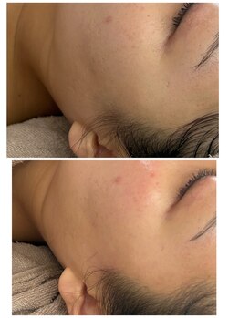 リノ(Lino)/マツヤニ＆世界一の美容液導入