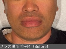 オアシスラグーン(OASIS LAGOON)/メンズ脱毛（症例4 before）