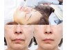 【たるみ改善】人気No.1 ウルトラリフト★即実感！メス不要で確実に引き上げ