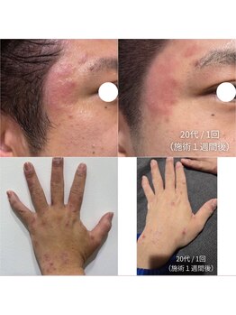 オニュ(onyu)/敏感肌、肌荒れの方にも！◎