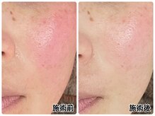 リアン/肌荒れ・赤みが気になる方へ