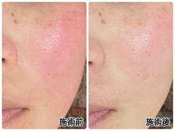 リアン/肌荒れ・赤みが気になる方へ