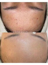 ゴールド 栄店(GOLD)/ニキビ改善コース 13回後