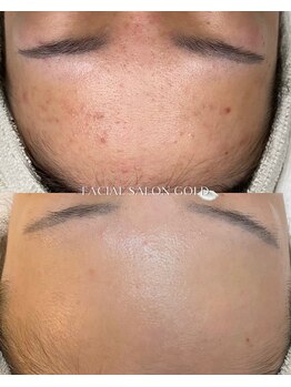 ゴールド 栄店(GOLD)/ニキビ改善コース 13回後