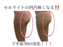 痩身革命 大宮店/施術写真（痩身）