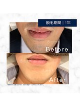 メンズクリア 八王子店/【メンズクリア】お客様の施術例