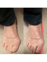 はりきゅう 藤田/インソールで足趾の変形を矯正！