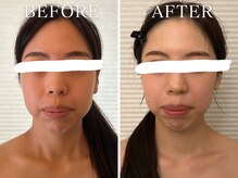 ヨサパーク ニコナ 三軒茶屋南口(YOSA PARK nicona)/水素の効果！肌のトーンアップ♪