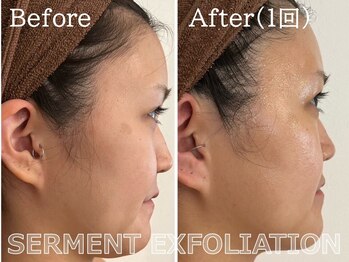 ルナステラ 七尾店/セルマン艶肌ピーリング