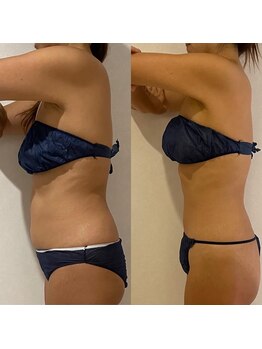 西院アロマリラクゼーションサロン シャルール/キャビテーション上半身70分