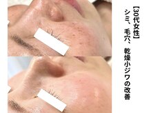 ボニータ(Bonita)/【Lit】ヒト臍帯幹細胞エステ