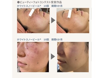 アイル イオン喜連瓜破駅前店/ホワイトスノーピール結果