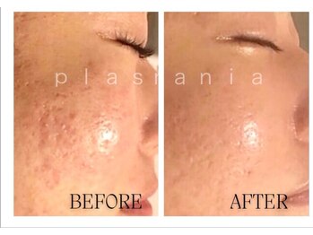 アールスタイルビューティ(R STYLE BEAUTY)の写真/人気NO1【肌改善、肌育】ニキビ改善、毛穴、肌改善lプラズマ×陶肌ピ-ル　18700円