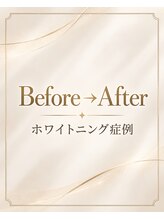 エクシアホワイトニング 岡崎店&nbsp;Before After