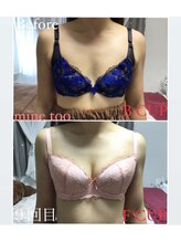 マイントゥー(mine too)/バストアップ症例